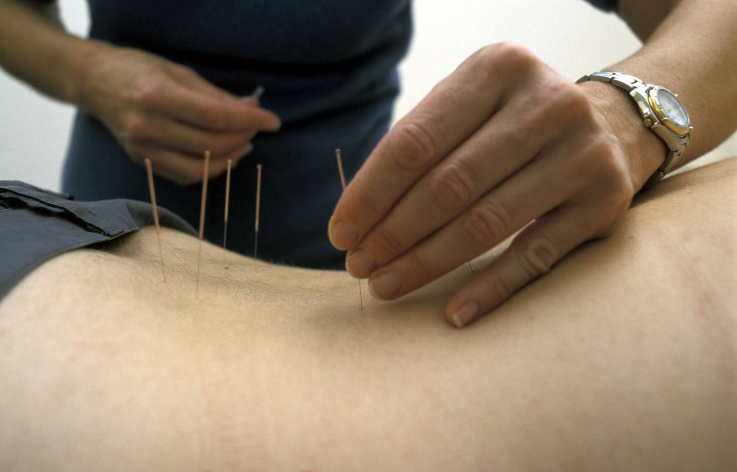 közös akupunktúra