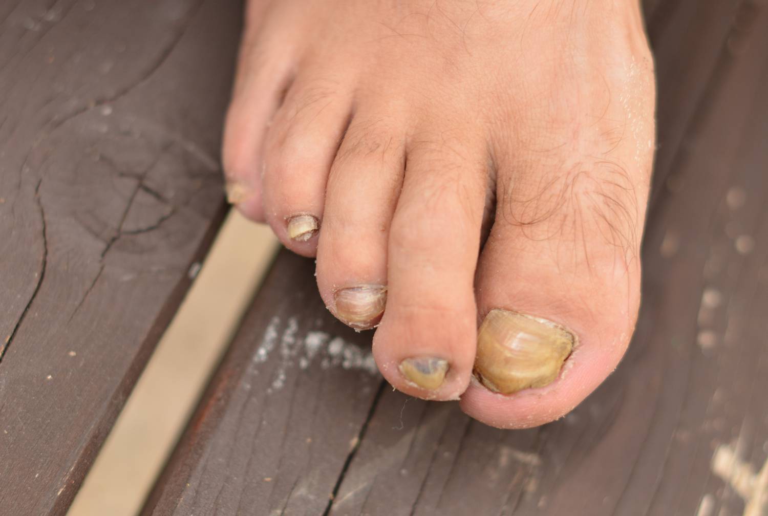 Láb- és körömgomba tünetei és kezelése, A lábujjak közötti viszketés és a kezelés