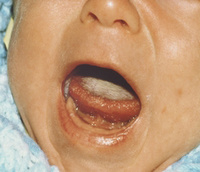 szájpenész tünetei csecsemőknél