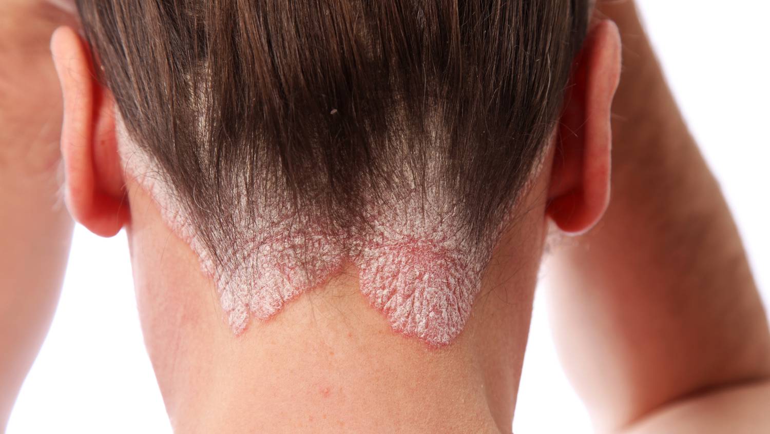 pikkelysömör és dermatitis a fej kezelésén