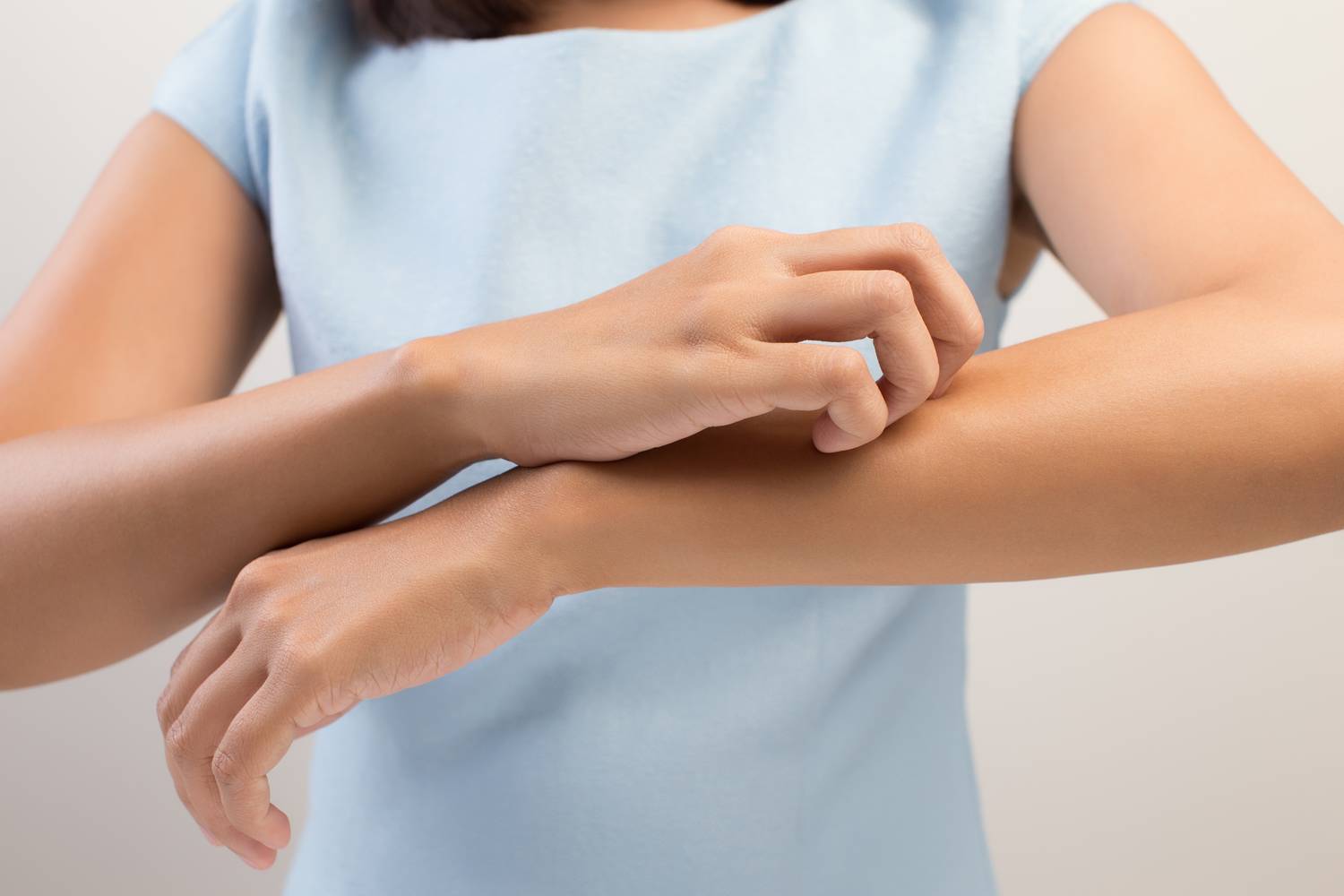 Kontakt bőrgyulladás kezelése a természet erejével | Gyógyszer Nélkül