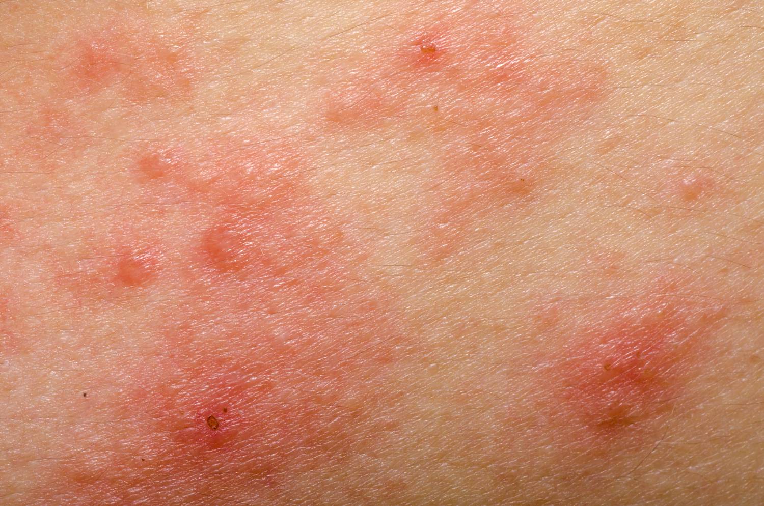 Milyen betegségre utalnak a vörös foltok?