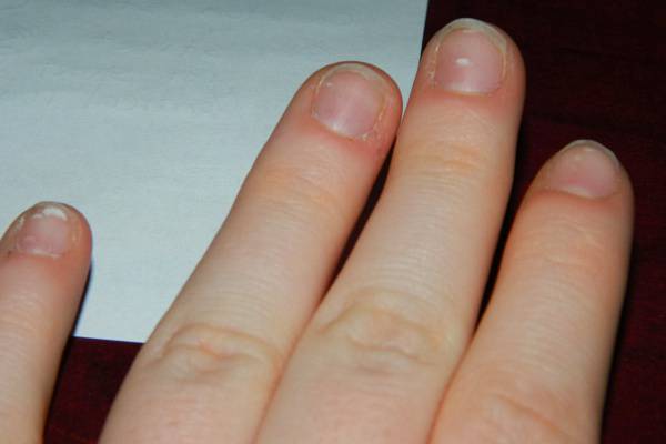 mit jelent a gomba néz a körmök az ujjak le lehet távolítani a körmöket, ha körömgombája van?