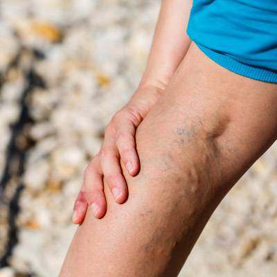 hirudo visszérrel gyógytorna gyakorlatok visszér a lábakon