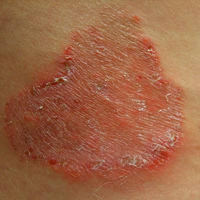 Bőrbetegségek: pikkelysömör, psoriasis, ekcéma kezelése gombákkal