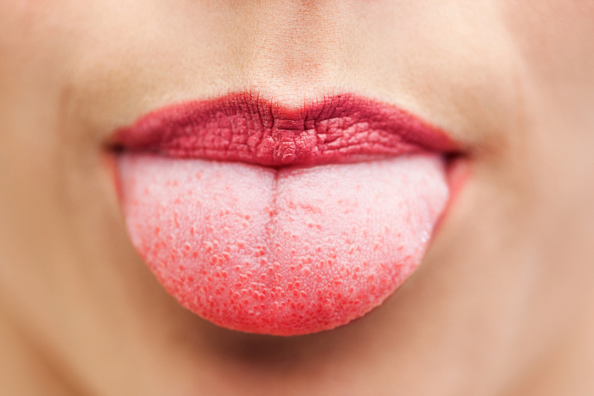 Az íny, a nyelv, a szájpadlás és a száj más részein a HPV okai és kezelése - Cirrózis - April