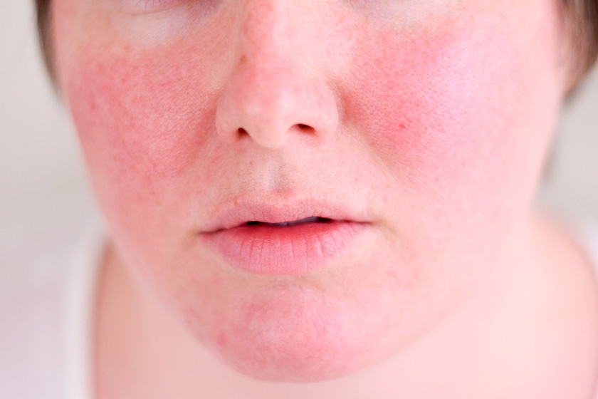 arcbőr betegség vörös foltok