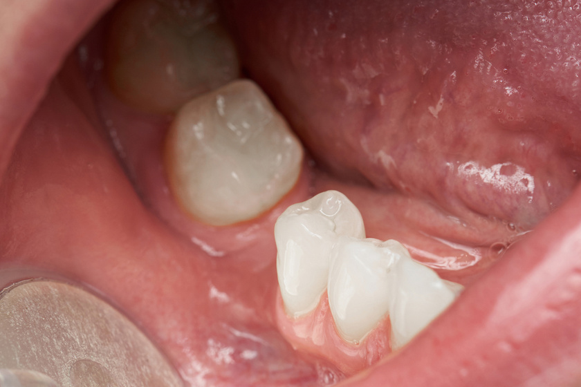 A rossz fogak okozhatnak látás romlást?