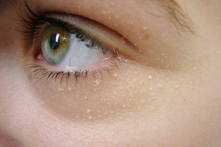 hogyan lehet eltávolítani a szem alatti vörös foltokat
