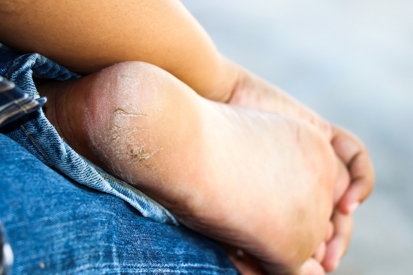 A lábujjak közötti sebek kezelése