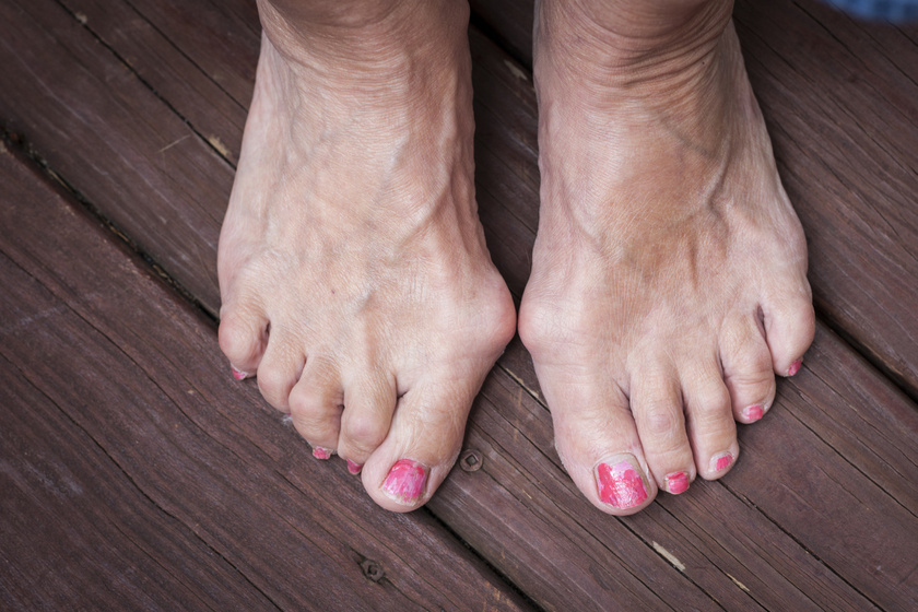 láb kisujj fájdalom hogyan kell kezelni a csípőízület coxarthrosisát