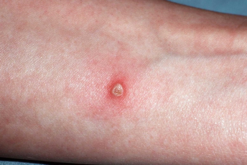 gyulladásos bőrbetegségek standard pikkelysömör kezelsi rend