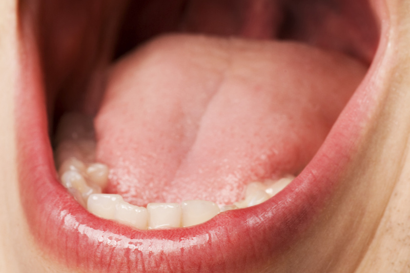 fehér nyelv acetonszaga a szájból