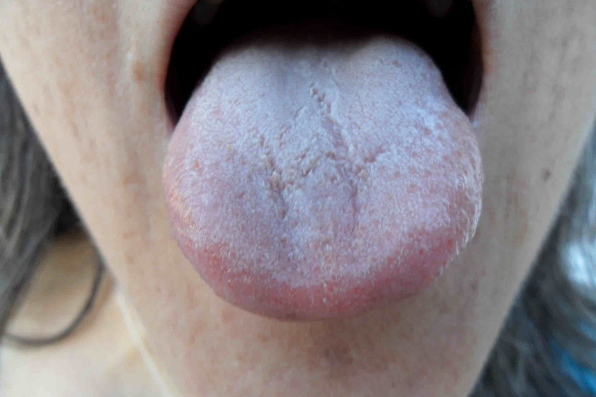 a nyelv fehér bevonata a paraziták jele