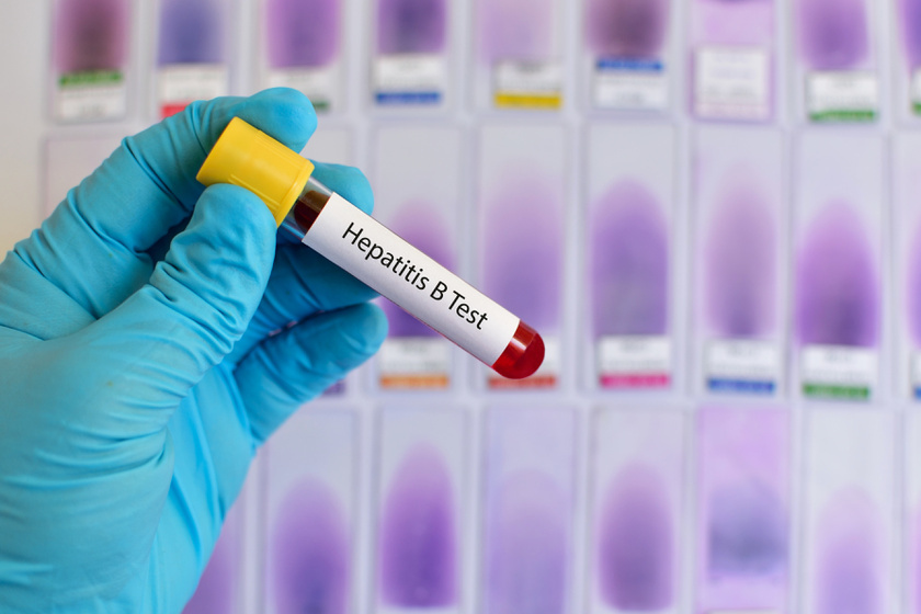 Hepatitis A (járványos májgyulladás) tünetei és kezelése - HáziPatika