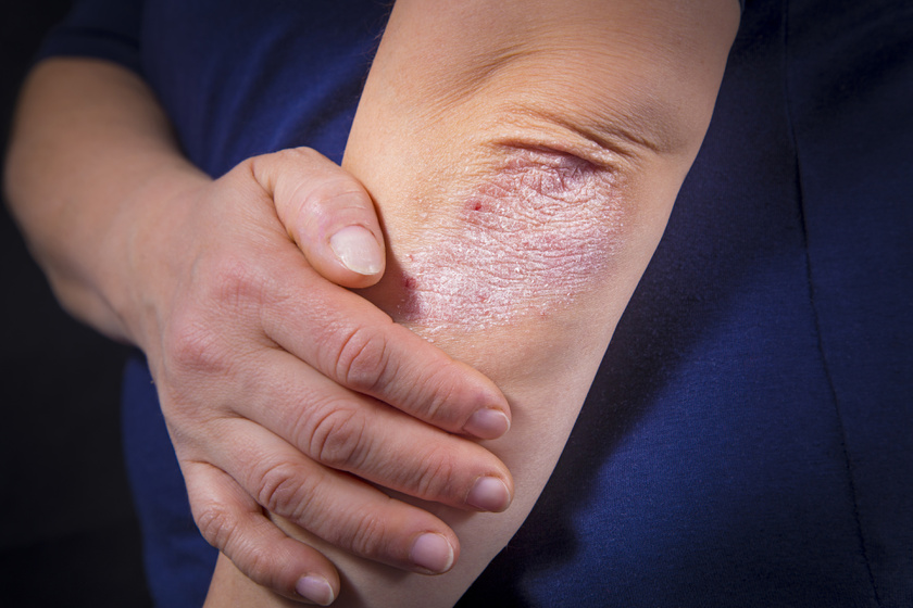 psoriasis skin condition vörösbarna folt a bőrön