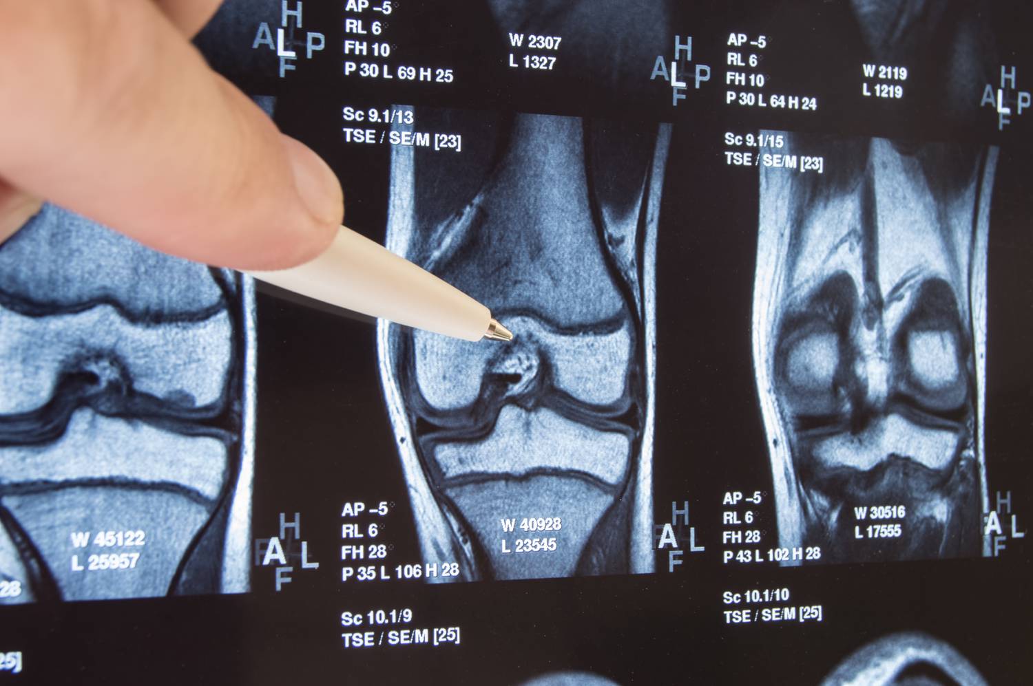 ujjízületi lézeres kezelés fáj a térd, hogyan lehet kezelni az artrózist