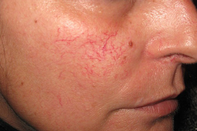 Hogyan lehet eltávolítani a vörös foltokat a pattanásokról az arcra - Pikkelysömör November