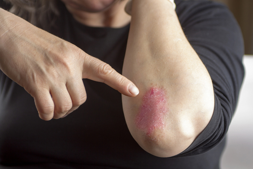 bőrgyógyászok a pikkelysömör kezeléséről vörös foltok a gyomorban és a combokban viszketnek