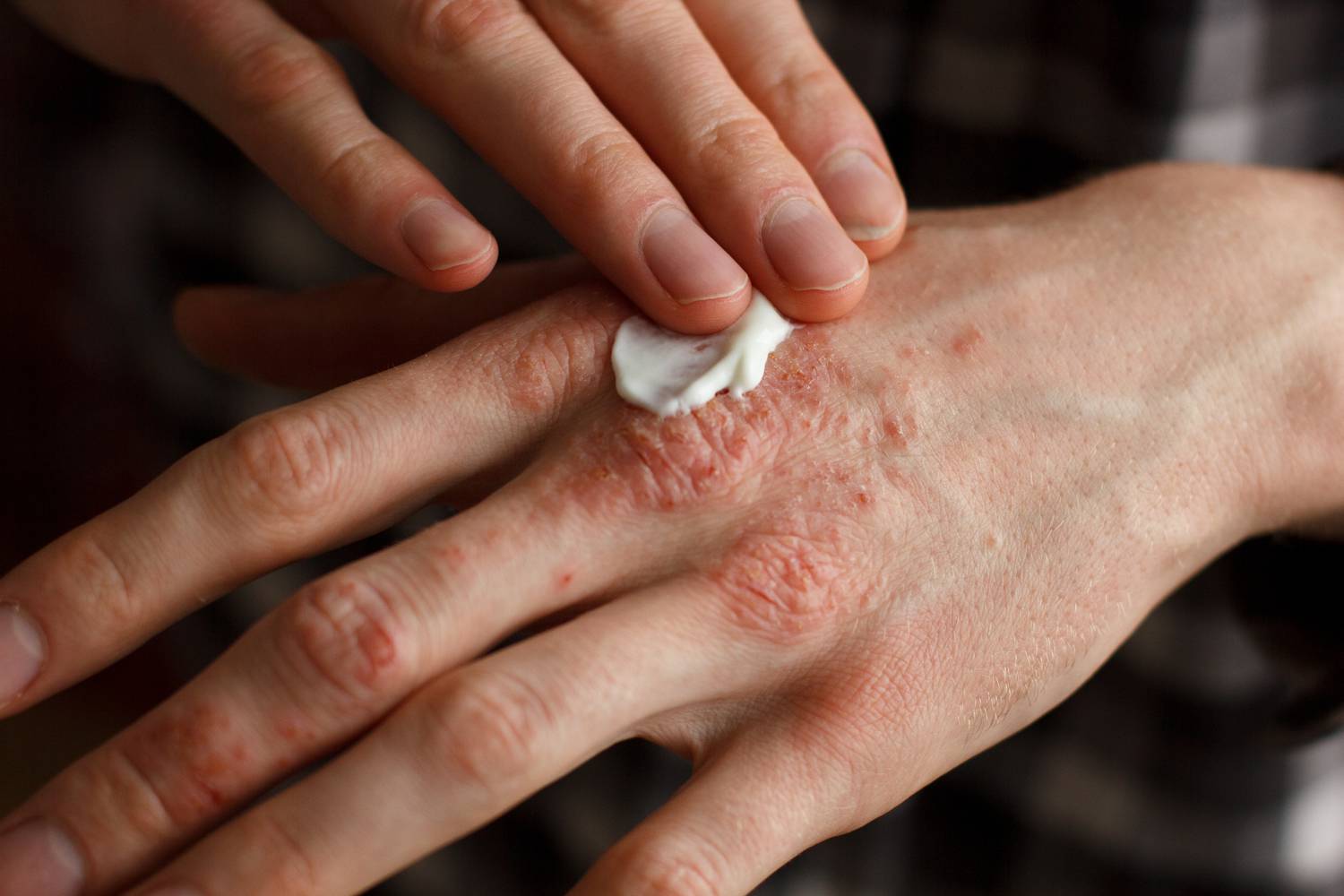 Ekcéma a kézen: egy fájdalmas bőrgyulladás
