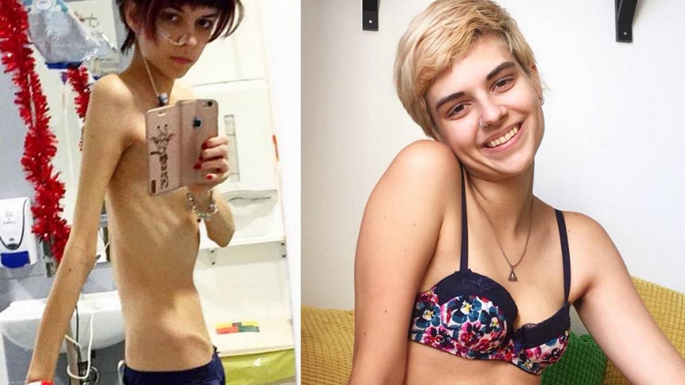 Különbség a diéta és az anorexia között