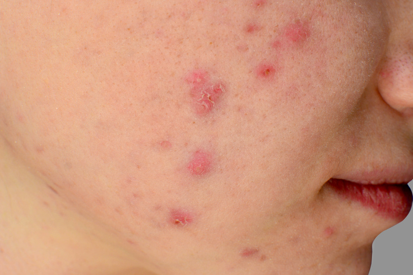 Bőrproblémák hormonzavar miatt – mely probléma mit jelezhet?