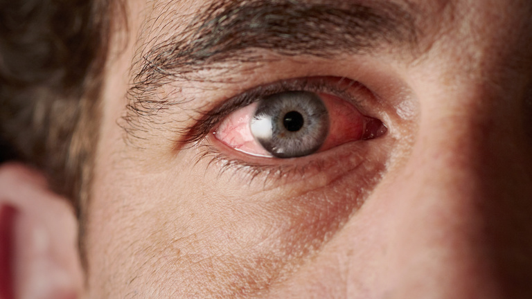 PharmaOnline - A száraz szem és kezelése