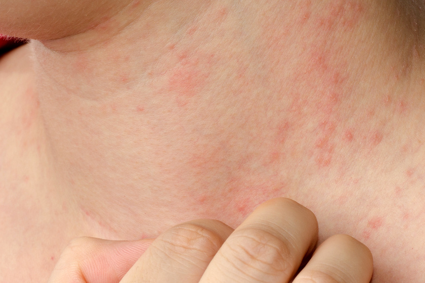 Bőrgombás megbetegedések tünetei
