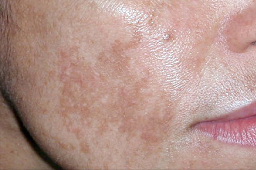 Milyen betegségre utalnak a vörös foltok? - Száraz vörös foltok az arcon és a nyakon
