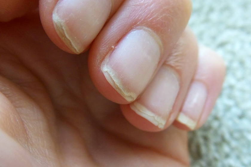 fungush nail fighting melyik fű megöli a köröm gomba