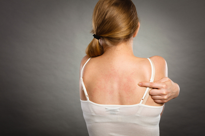 A leggyakoribb bőrrákos elváltozások - Képgaléria Vörös foltok jelennek meg a nyakon, lehámozódnak