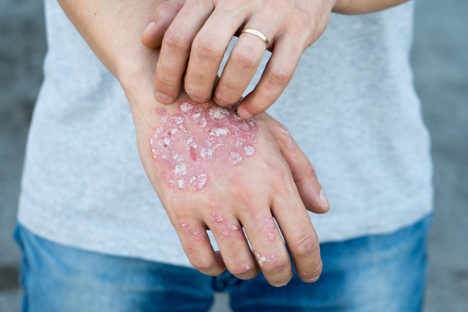 nail psoriasis dermnet spray pikkelysömör bőr sapka