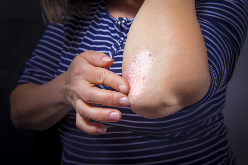 gyulladásos bőrbetegségek orvosi központok pikkelysömör kezelésére