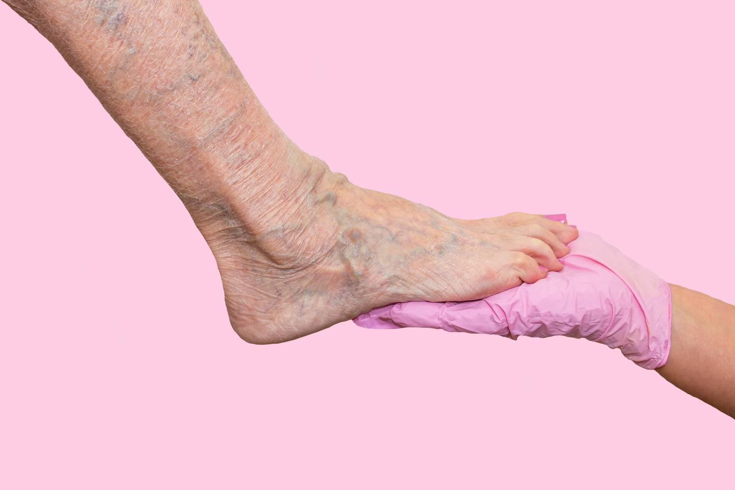 Visszér a lábárofuszkinga.huélyes-e Fájdalom és állapot a varikózisos lábszárral