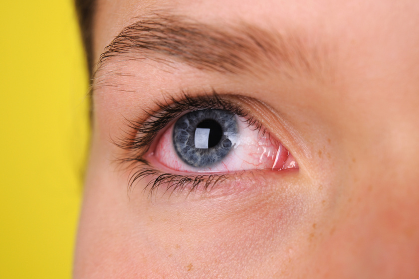 vörös szemek a magas vérnyomástól a hipertónia fizetett vizsgálata