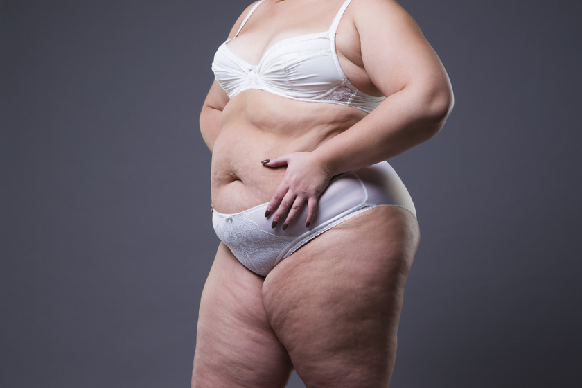 fogyás kórosan elhízott nő