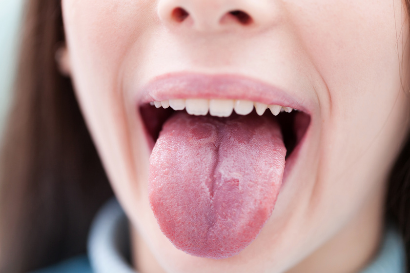 fájó nyelv fogyás