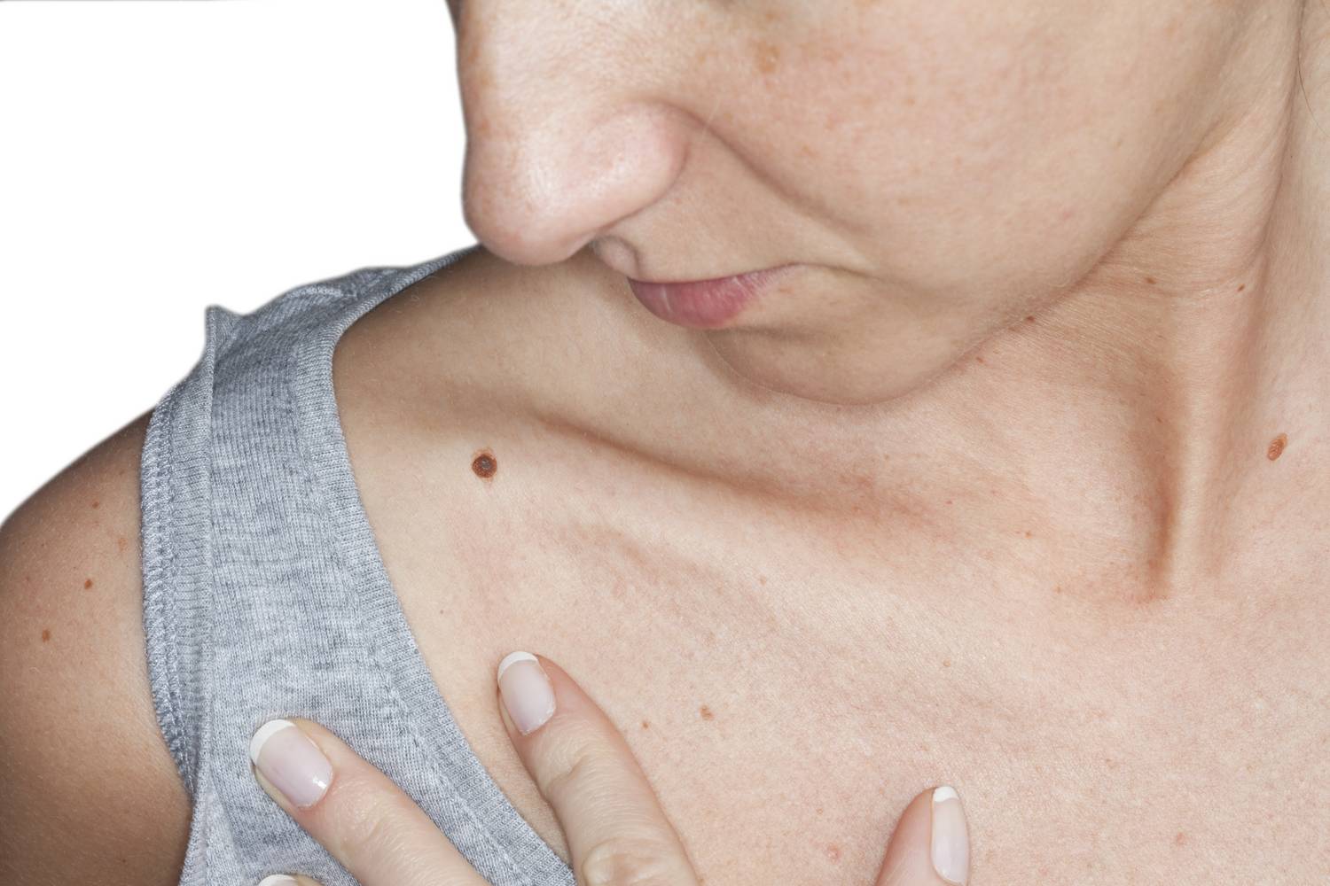 a bőrrák átterjed gyomorrák patológia