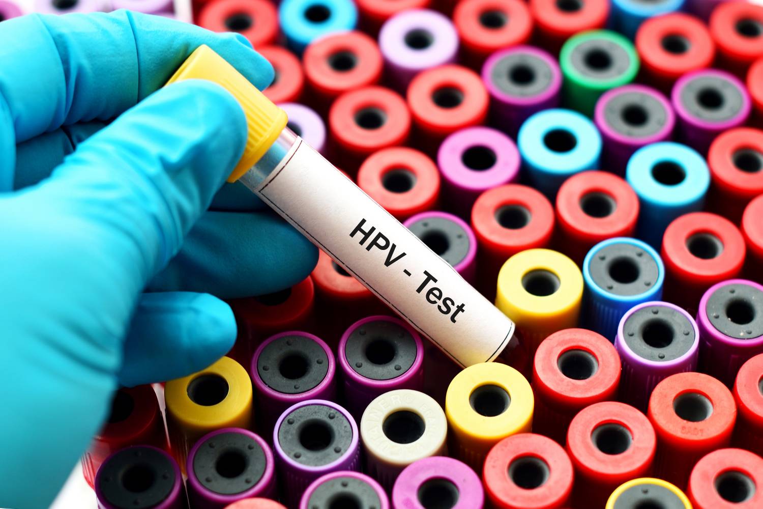 HPV-fertőzés - Tudástár