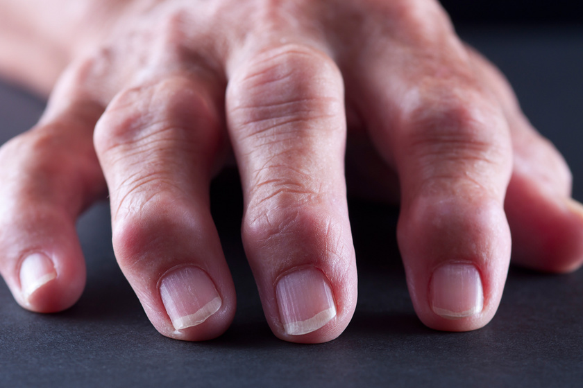 Kéz deformáció rheumatoid arthritisben, Ízületi gyulladás (reumatoid artritisz)