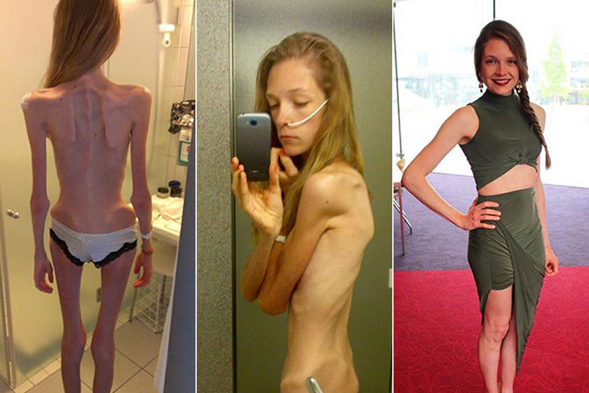 Hogyan kezeljük az anorexiát - a valós élet történeteit