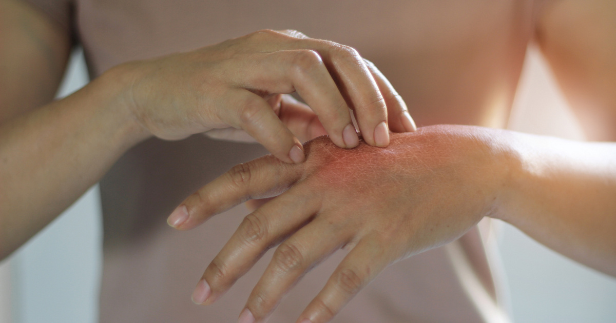 legjobb gygyszerek a pikkelysmr kezelsre vörös foltok jelentek meg a kéz bőrén fotó