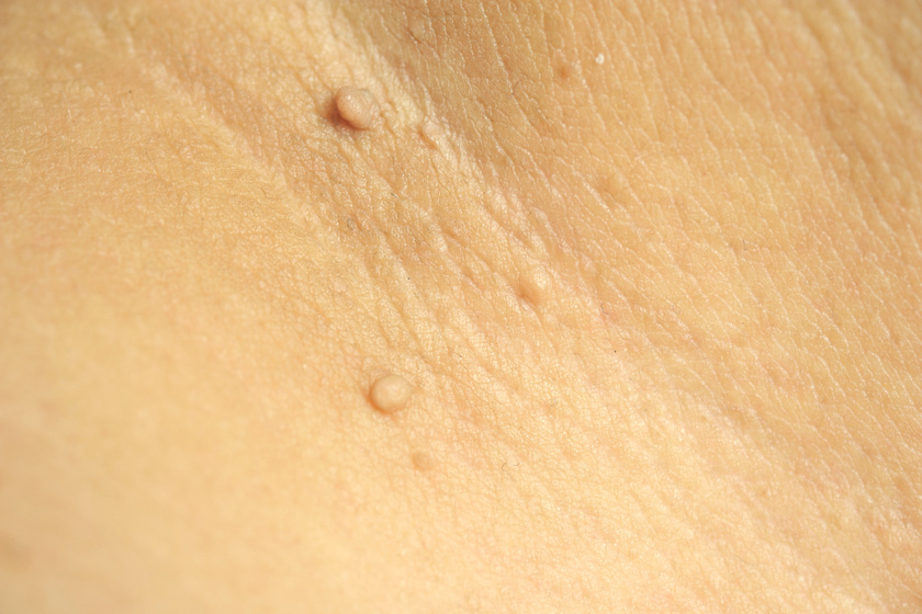 apró kinövések a hónalj alatti bőrön a rossz lehelet okozza a felnőttek kezelését