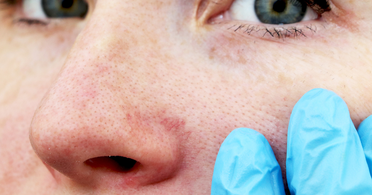 Bőrkiütés vörös foltok formájában az arc felnőtt fotóin Napallergia tünetei és kezelése