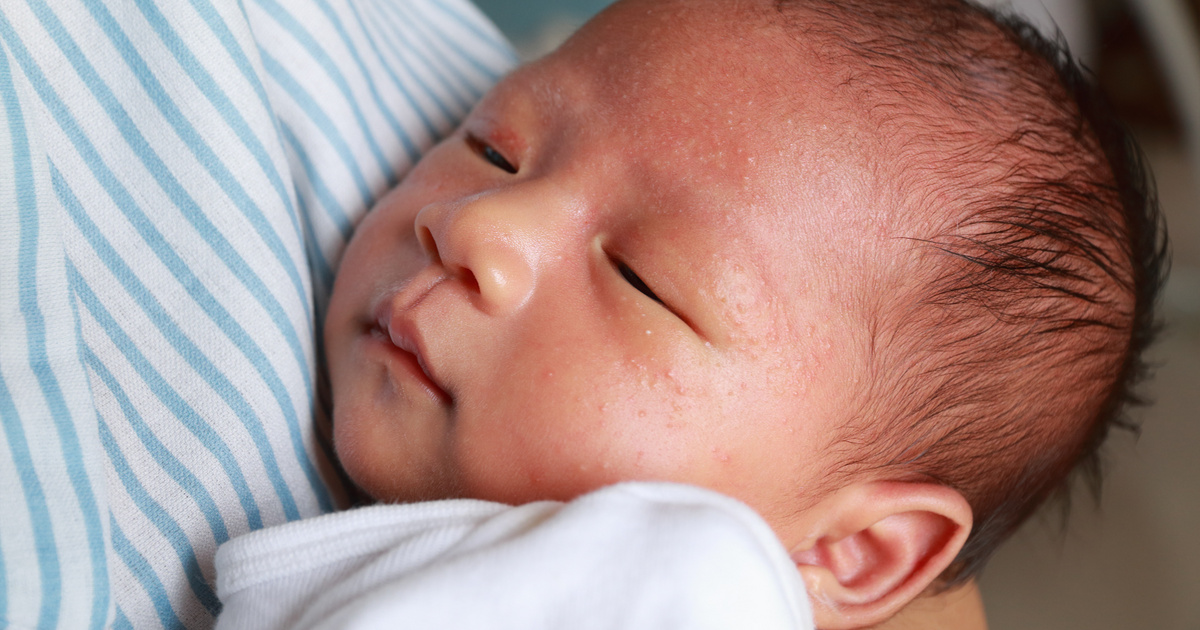 Nyugtalanul alszik a baba? Lehet, hogy ételallergia okozza!