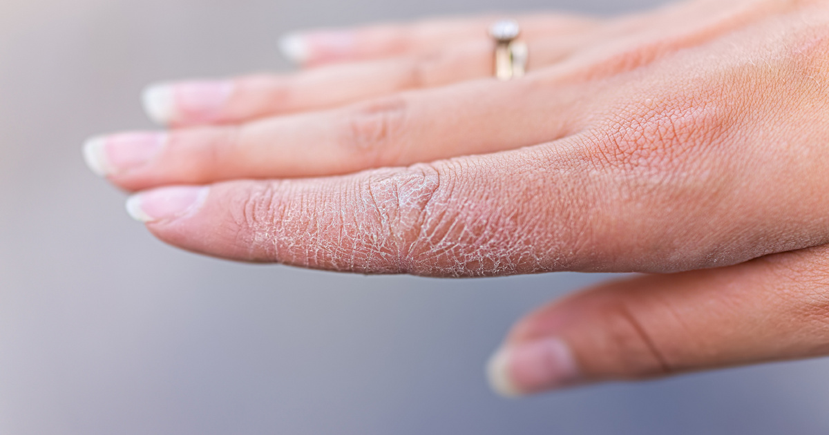 Együttélés a cukorbetegséggel – A kéz és láb ápolása nyáron