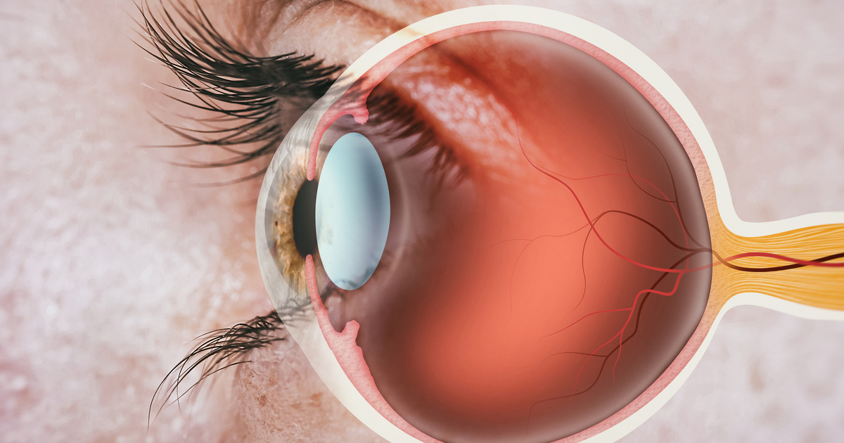 a diabétesz retinopátia képek a diabétesz