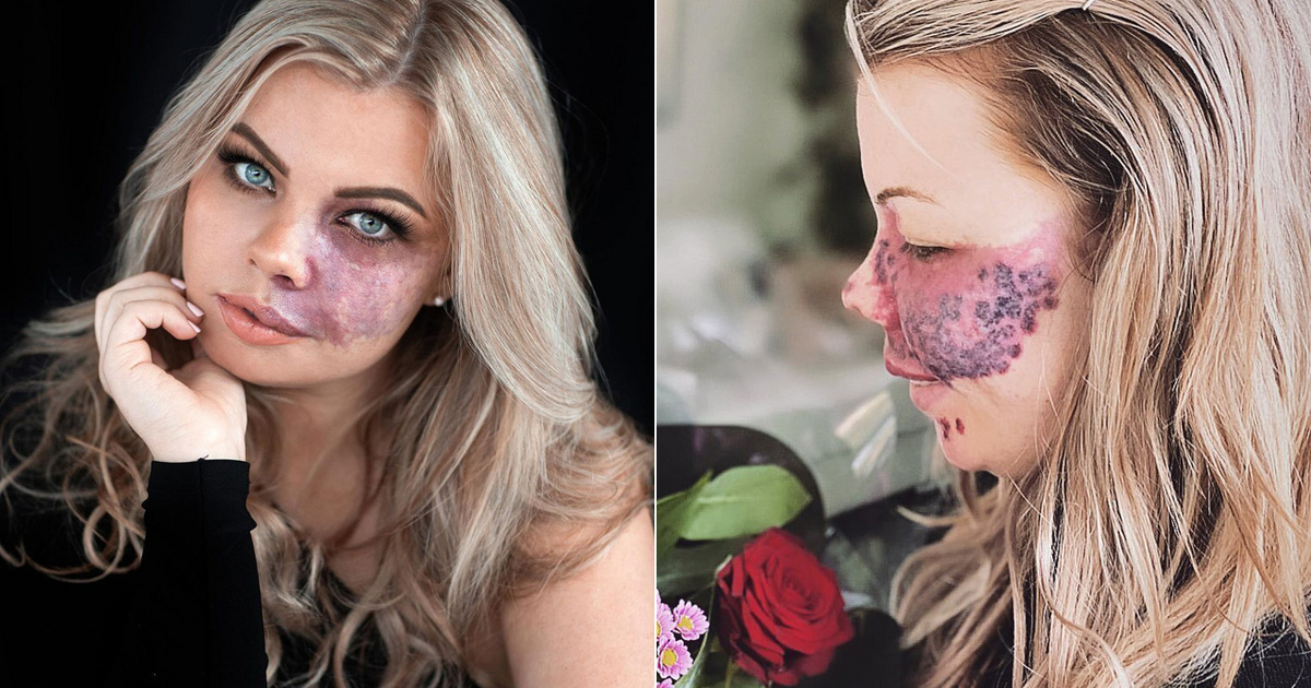 Csúfolták és megalázták a fiatal lányt bőre miatt: ma már modellként tündököl a 29 éves Amy