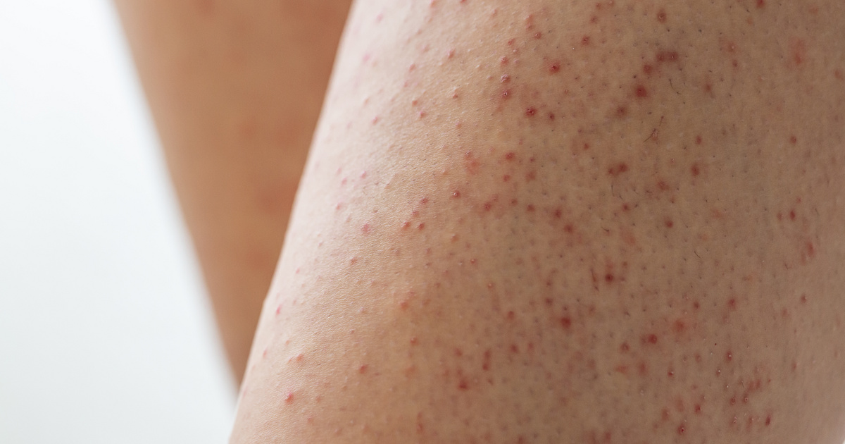 Tilos nyomkodni, ha ilyen dudort látsz a bőrödön: innen ismerhető fel a keratosis pilaris