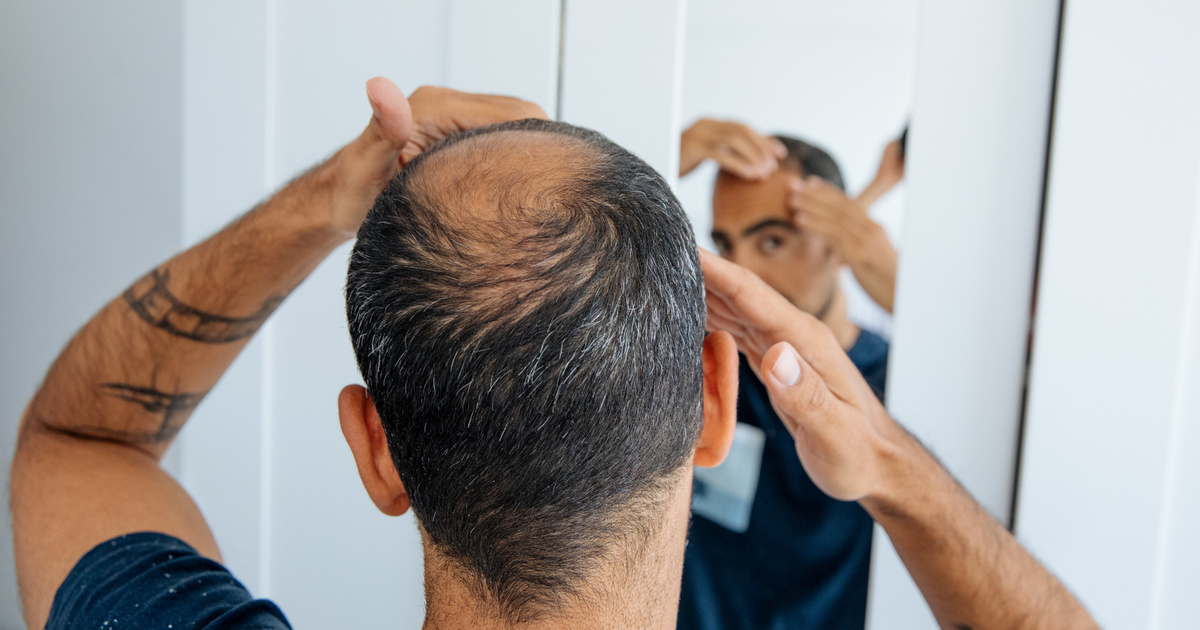 Nem a stressz, nem az anyánk – ezeken a dolgokon múlik valójában a kopaszodás